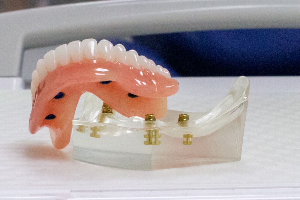 Implant retained Denture - 3dental